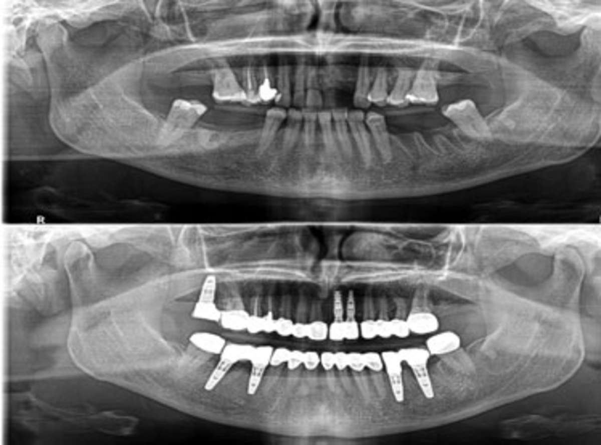 Multiple Implants