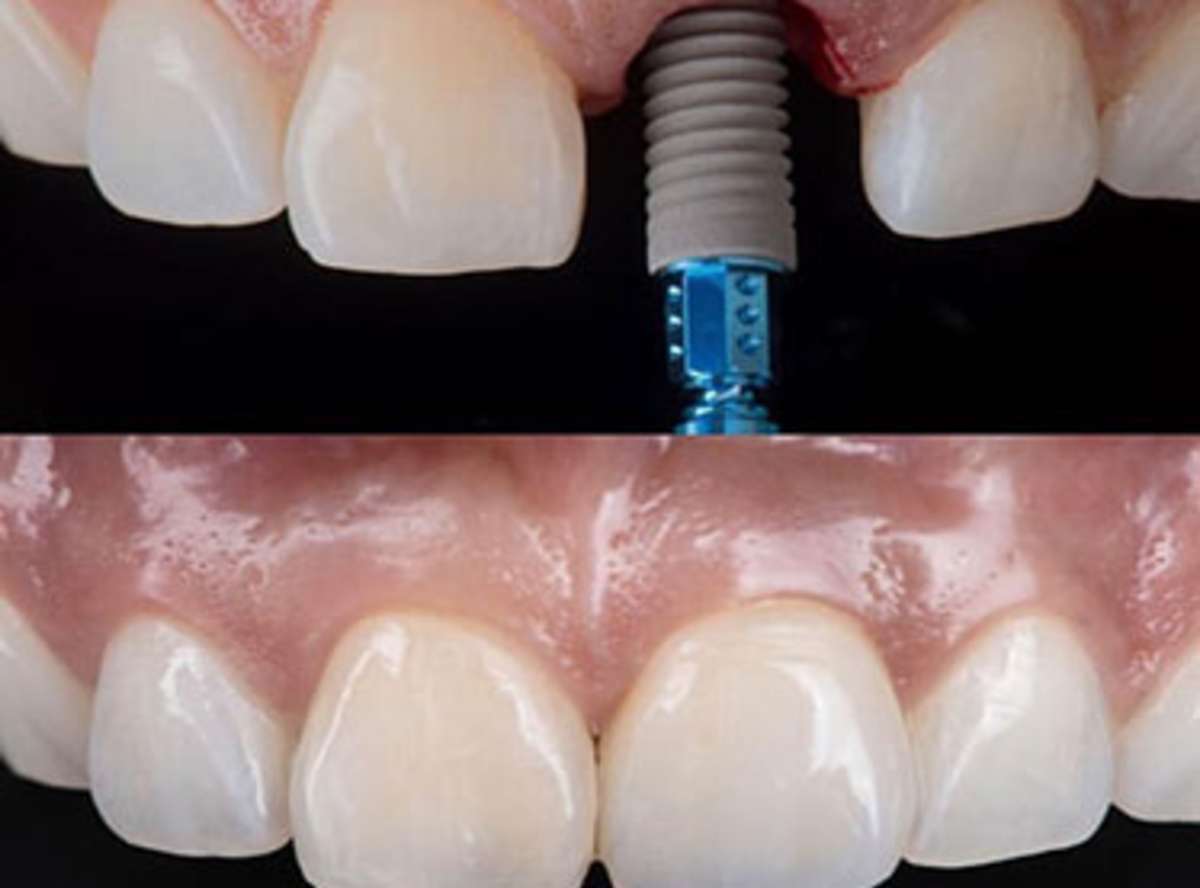 Single Tooth Implant